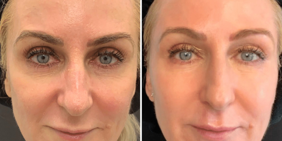 Botox Garner NC: Your Complete Guide to Smooth and Youthful Skin