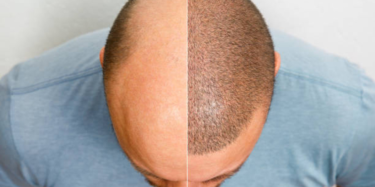 What to Expect Before, During, and After a Hair Transplant