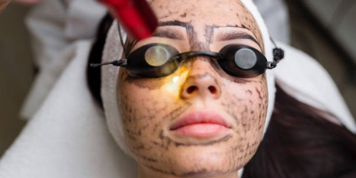 Laser Carbon Peel for Minimizing Enlarged Facial Pores
