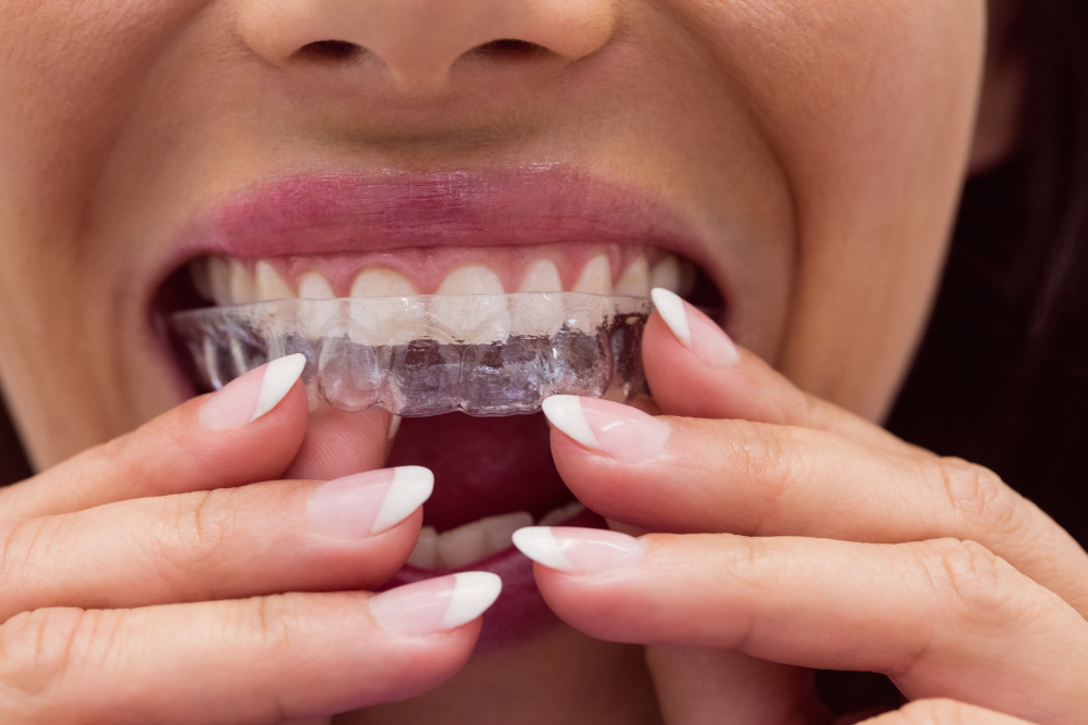 Invisible Dental Aligners vs. Metal Braces: Which Is Right for You?  -
