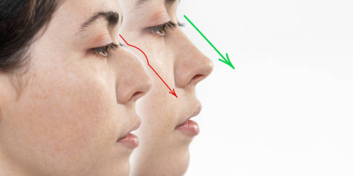 Non-Surgical Rhinoplasty in Riyadh: Quick Alternatives Explored