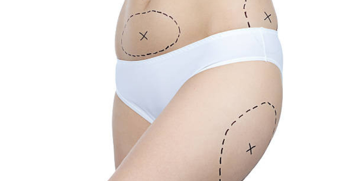 Laser Liposuction Procedure Insights for Better Results