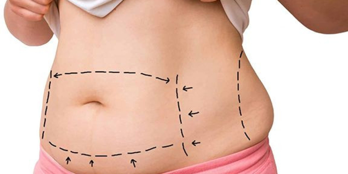 Transform Your Silhouette with BodyTite