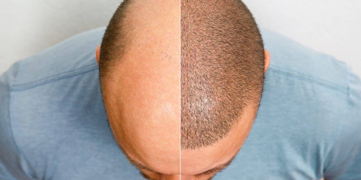 How Much Does a Hair Transplant Really Cost?