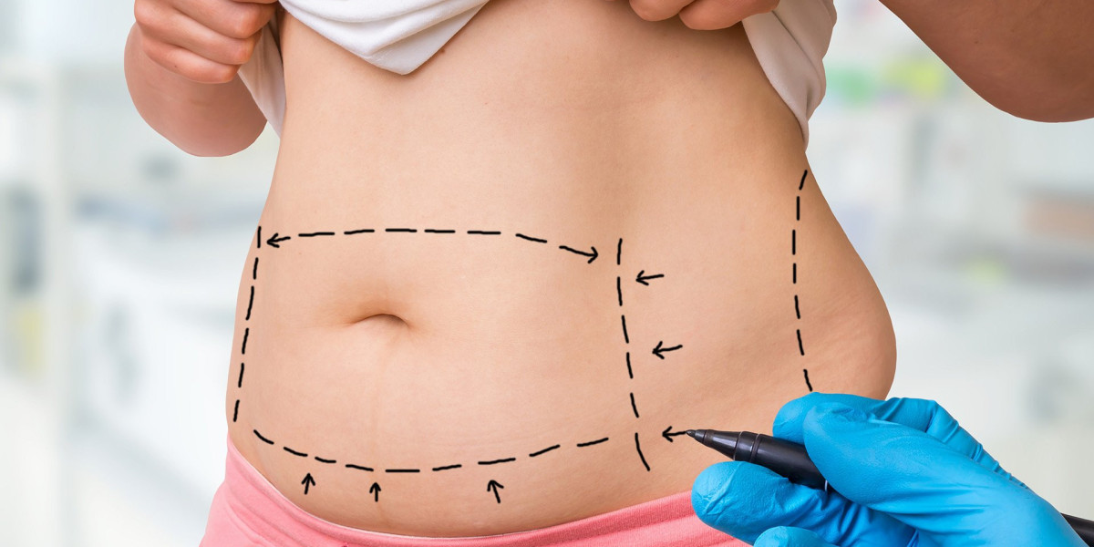 Why Liposuction Remains the Gold Standard for Fat Removal