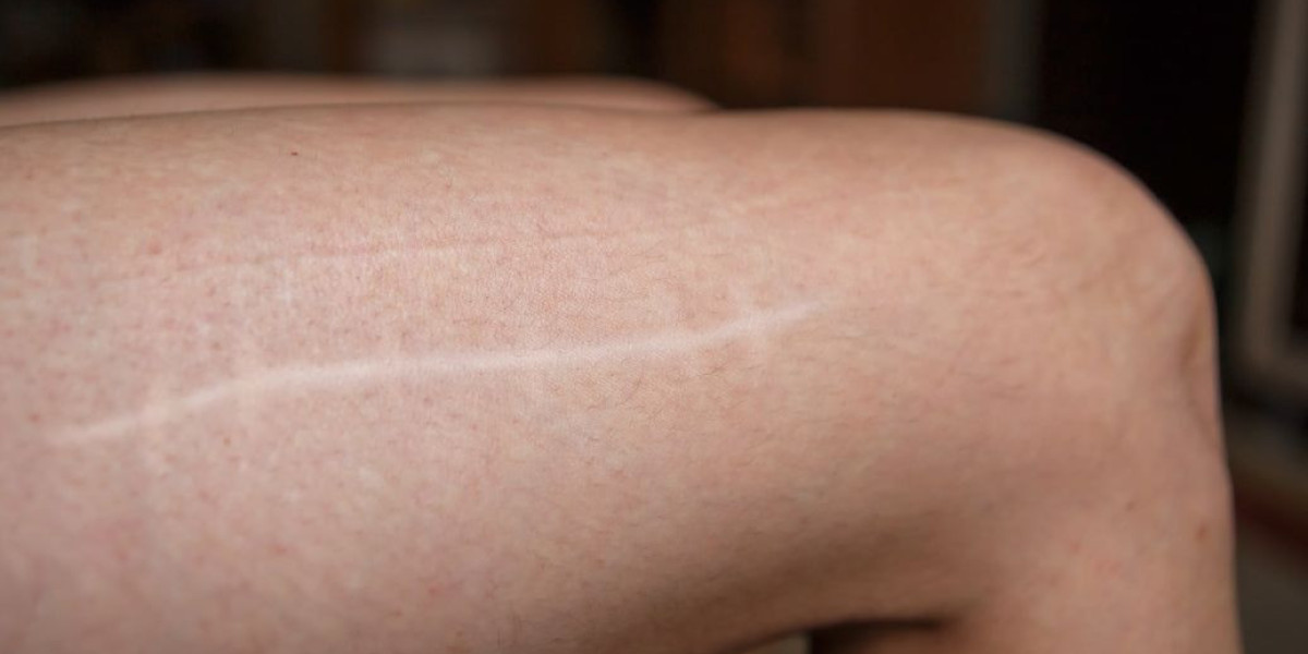 Expert-Led Laser Scar Removal at Royal Clinic