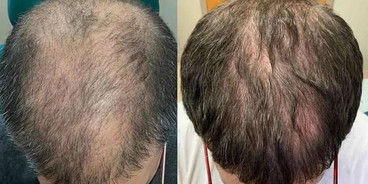 زراعة الشعر لاستعادة مظهر الشعر الصحي والمتوازن