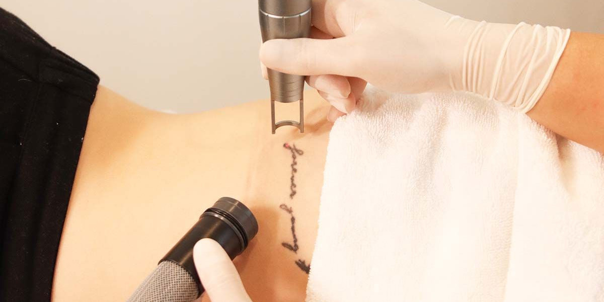 Laser Tattoo Removal Designed for Smooth, Clean Results