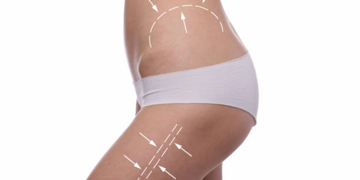 Body Sculpting Procedure Explained for Fat Reduction Solutions