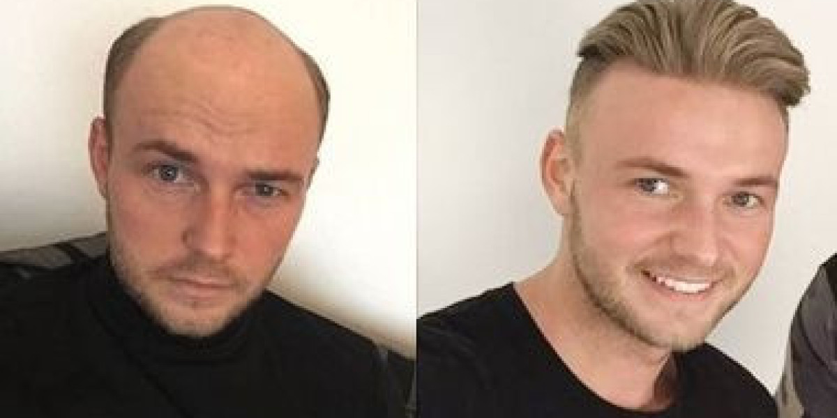 Hair Replacement Solutions for Men Experiencing Hair Loss