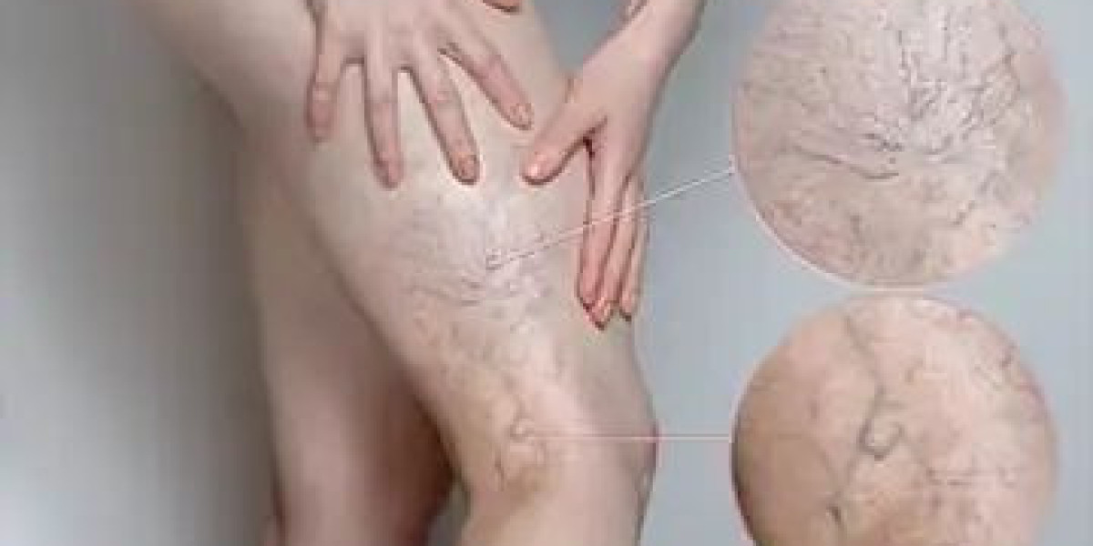 Varicose Veins Treatment That Improves Circulation | Royal Clinic