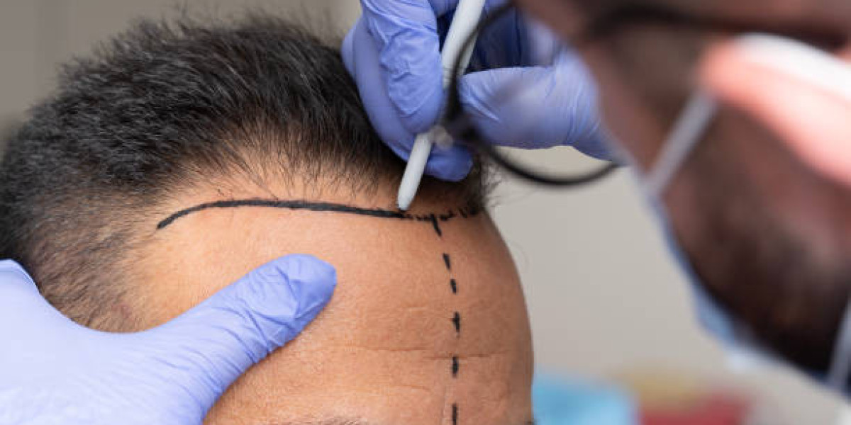 How Hydrate Scalp During Hair Transplant Recovery?