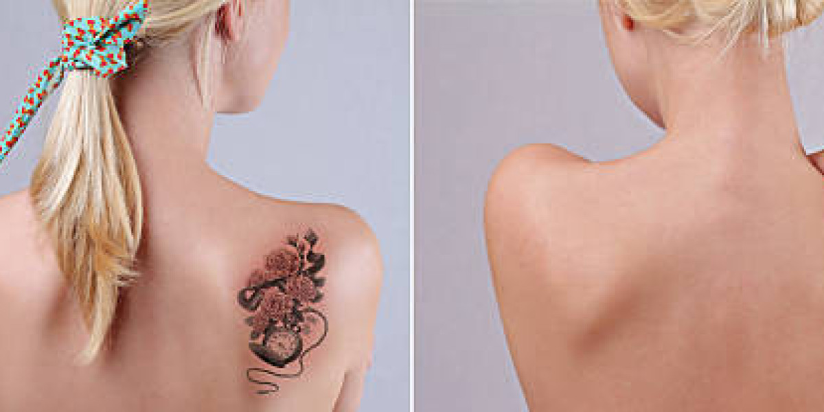 Laser Tattoo Removal Safety Guidelines for Healthy Skin