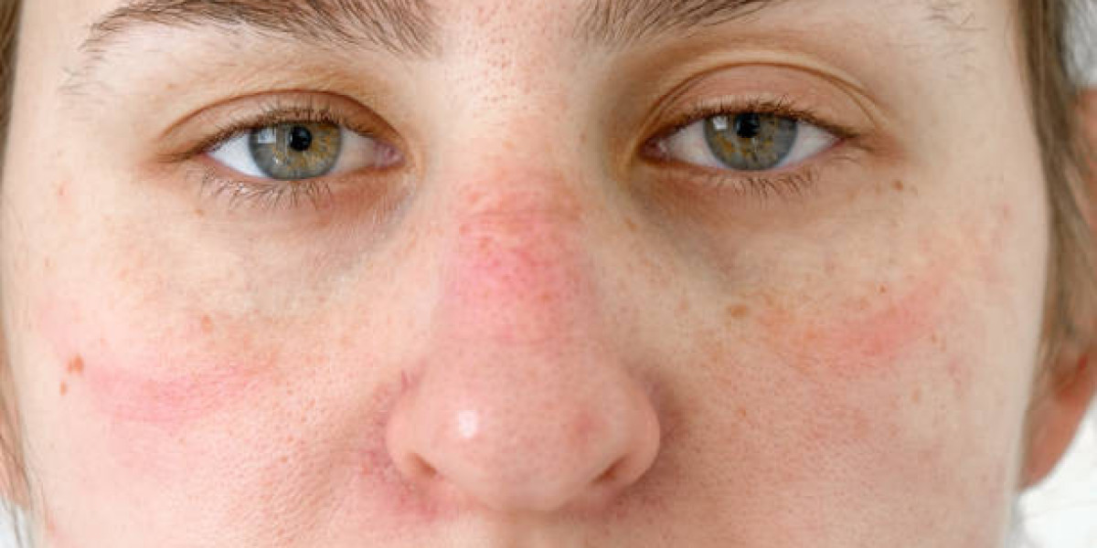 Chronic Red Skin by Nose: Causes, Treatments, and Tips