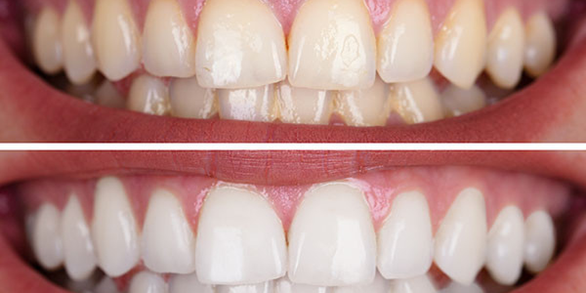 How Teeth Whitening Treatments Enhance Smile Brightness