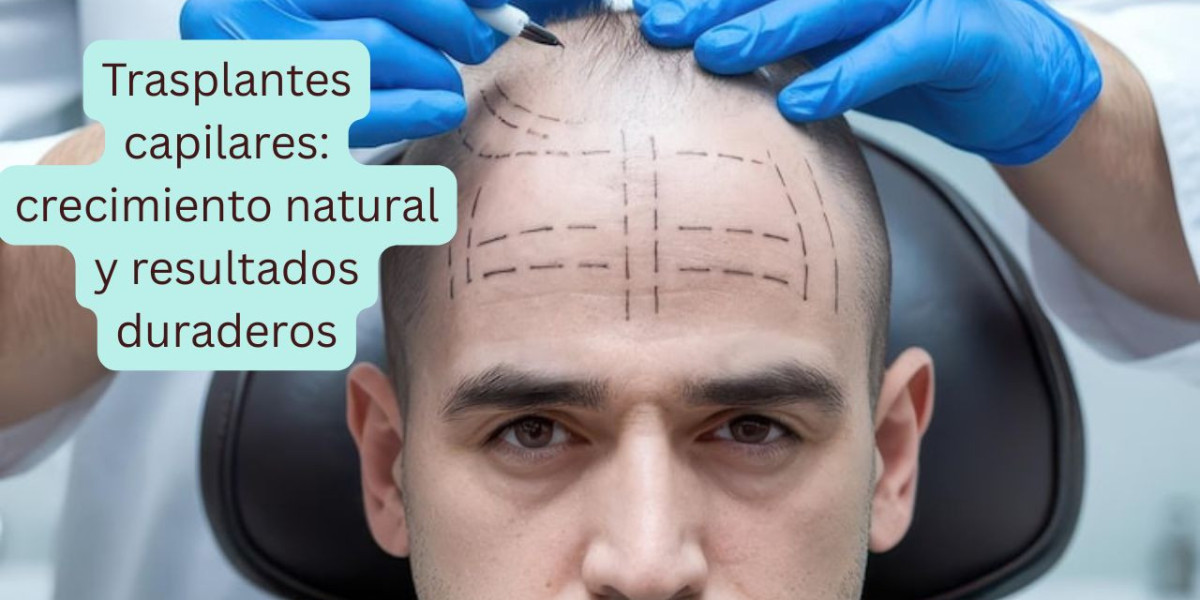 Trasplantes capilares: crecimiento natural y resultados duraderos