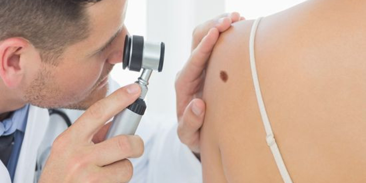 Understanding the Cost and Procedure of Mole Removal in Dubai