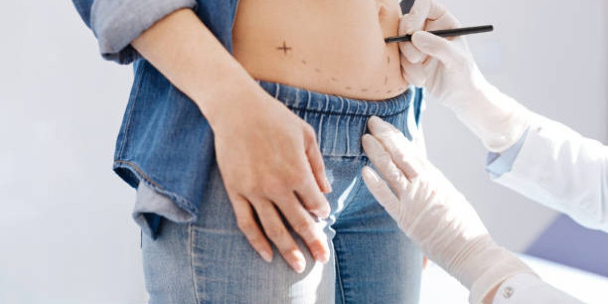 How Seromas Resolve in Liposuction Procedure?