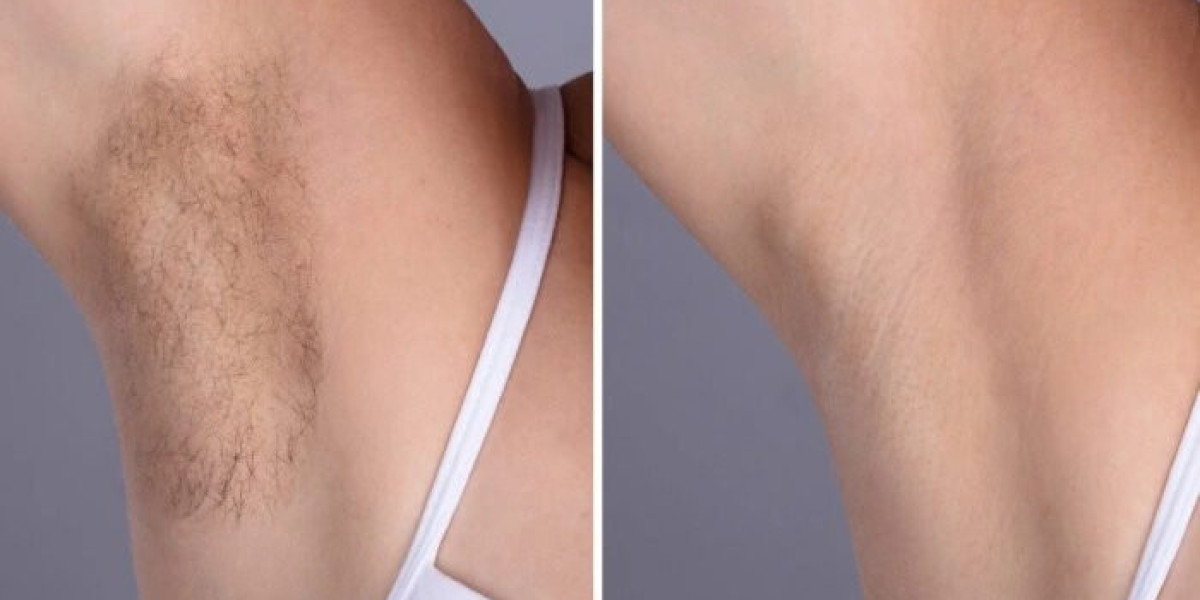 Proven Care by the Best Plastic Surgeon in dubai: laser hair removal