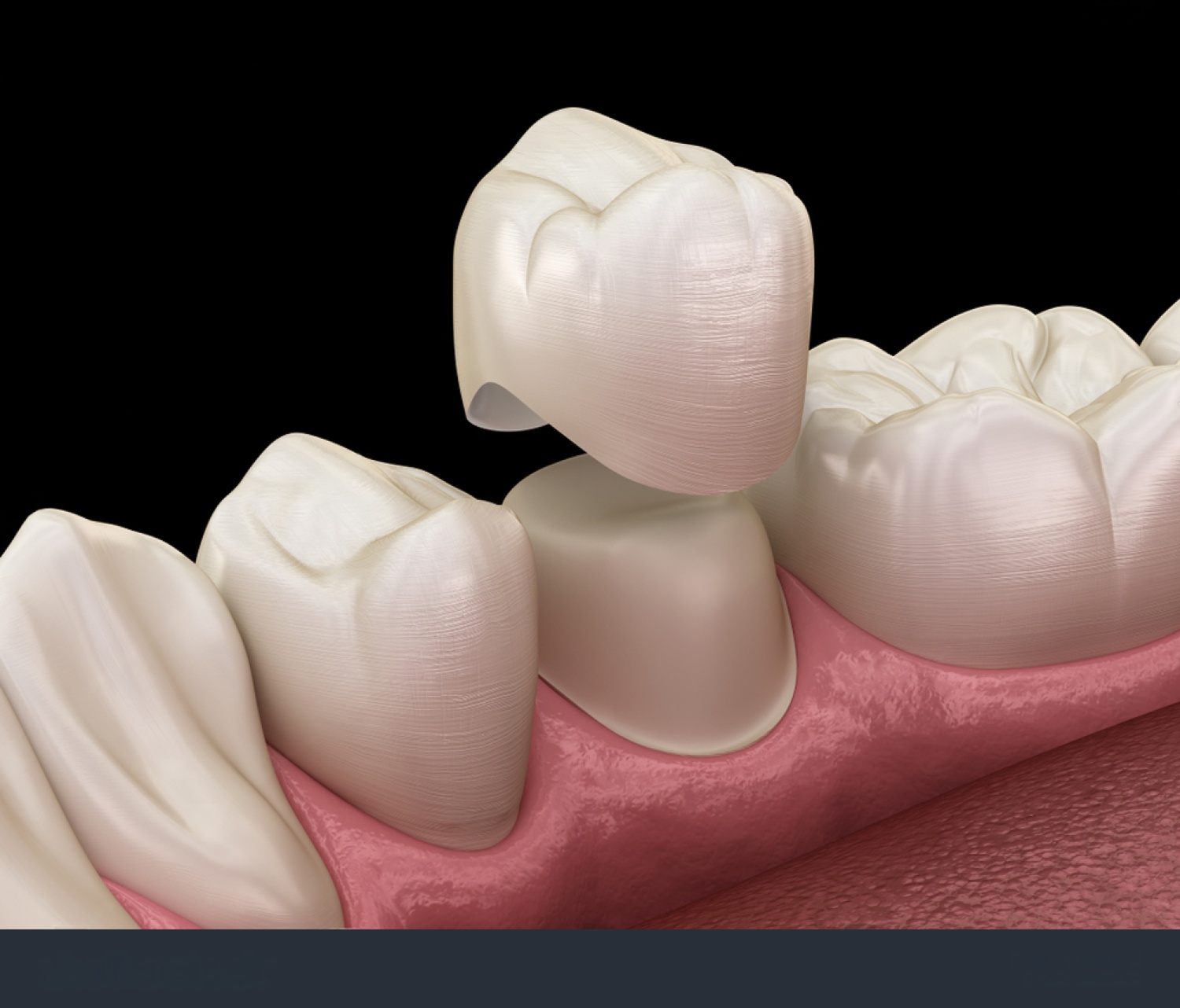 Why Your Crown Feels High or Uncomfortable (And How It’s Fixed) - Highlands Ranch CO Dentist | Alpine Vista Dental