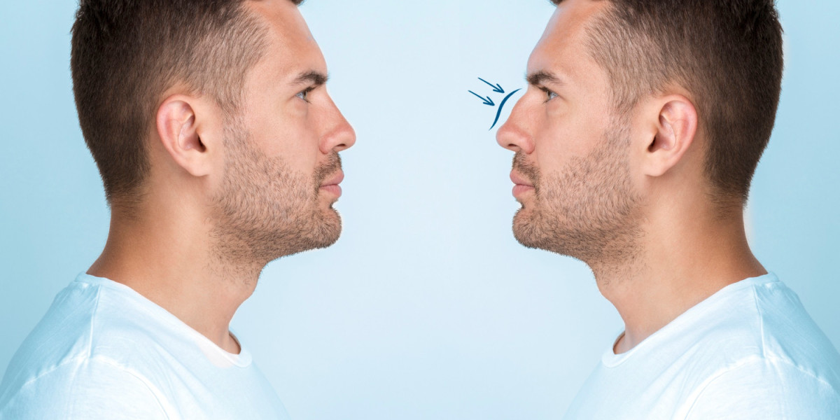 How Rhinoplasty Can Improve Both Looks and Breathing