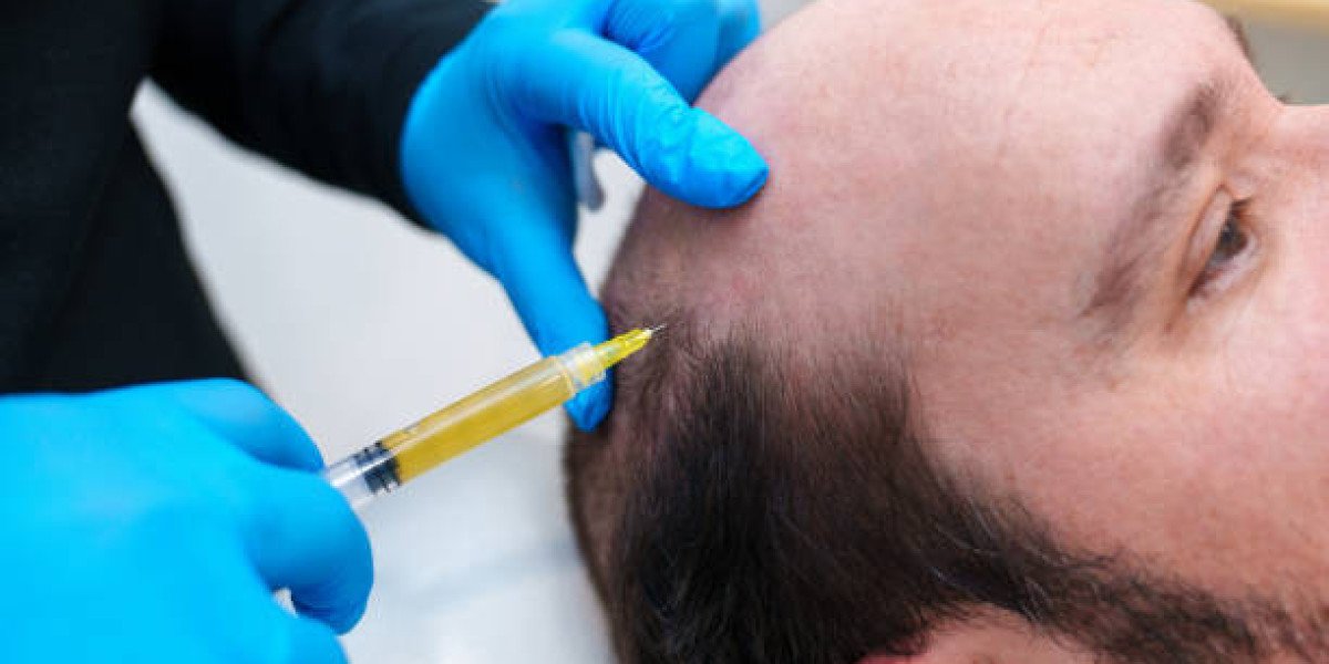 PRP Hair Treatment in Dubai vs. Minoxidil: Which Works Better?