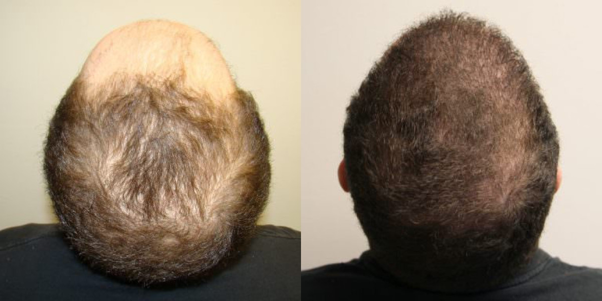 Hair Transplant in Dubai: Understanding the Procedure