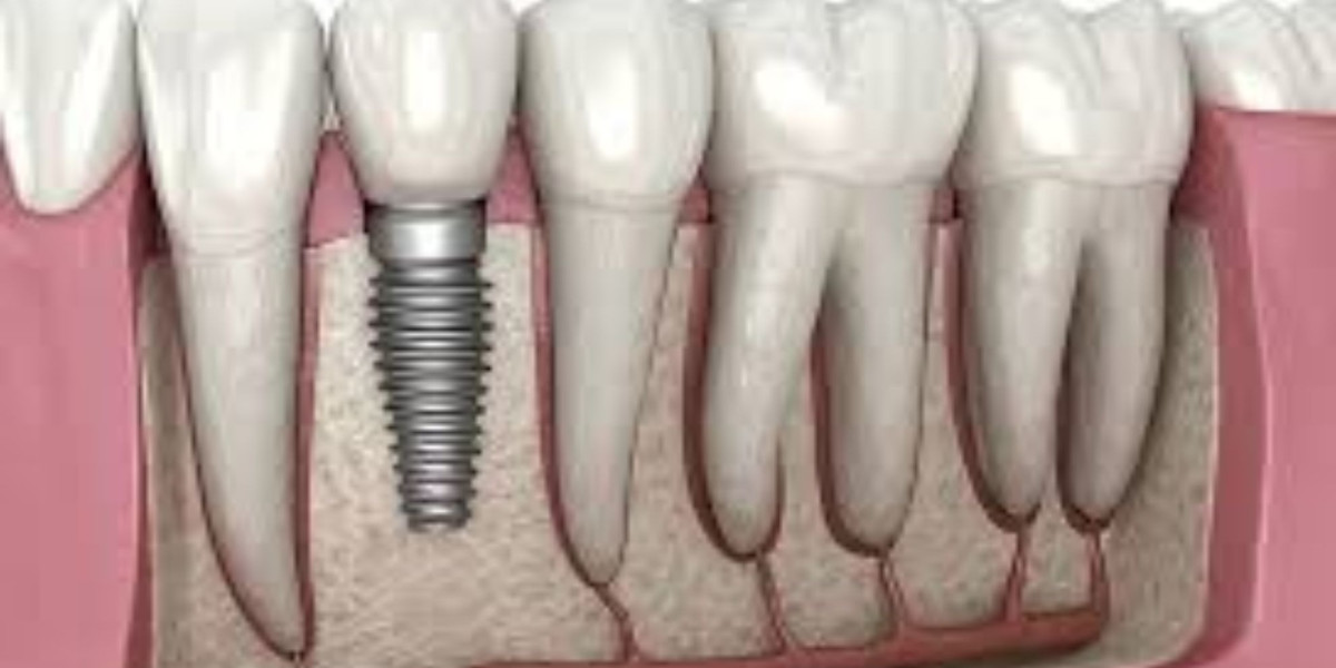Everything You Need to Know About Dental Implants for Missing Teeth