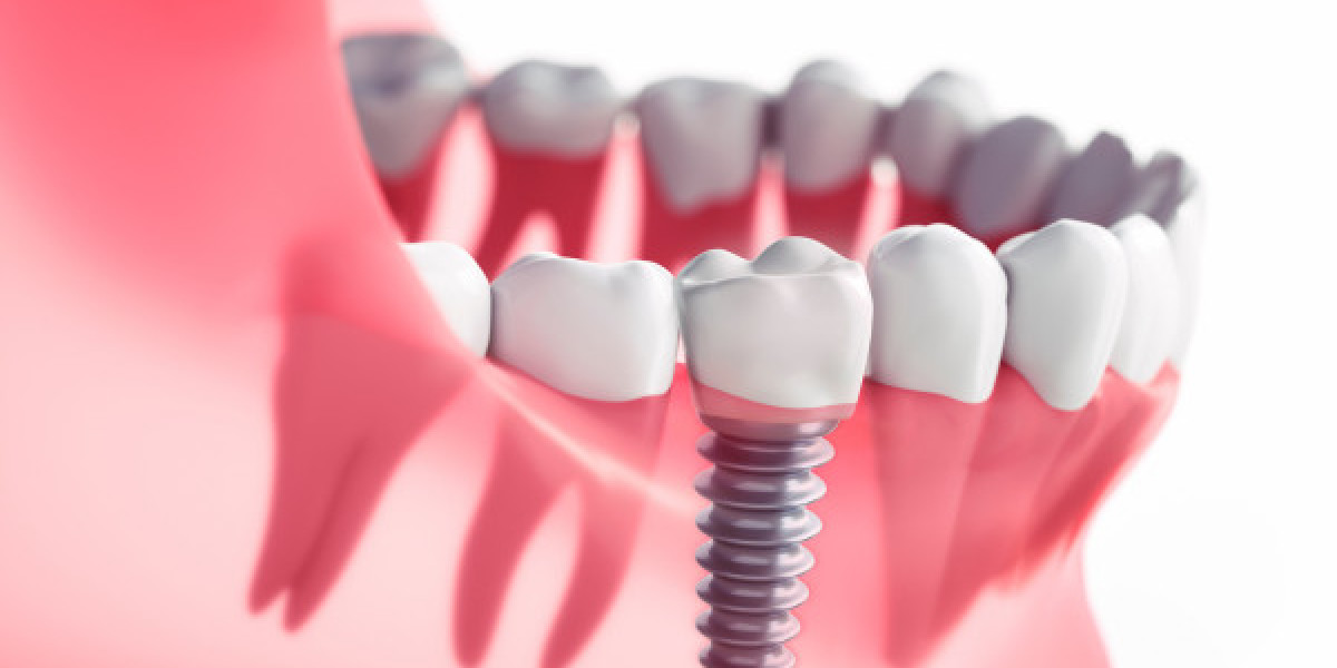 Dental implants Redefining Smile Aesthetics With Strong Reliable Design