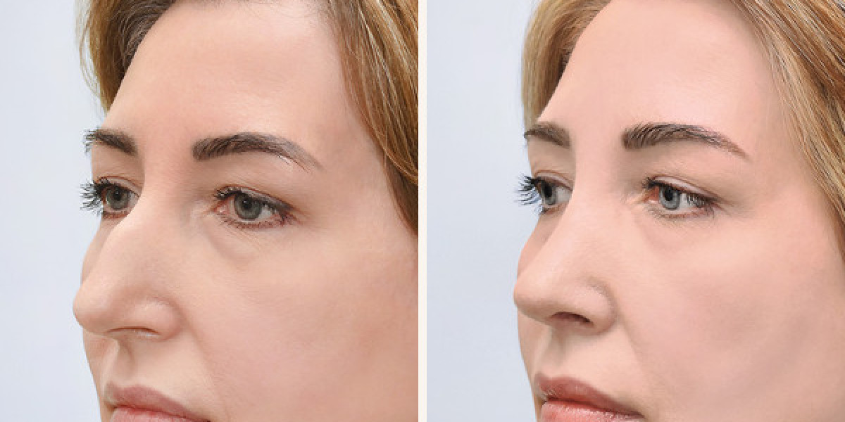 Rhinoplasty for Beginners: A Step-by-Step Overview