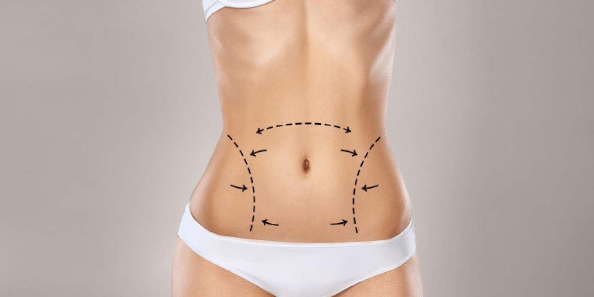 Can Liposuction Remove Stretch Marks?
