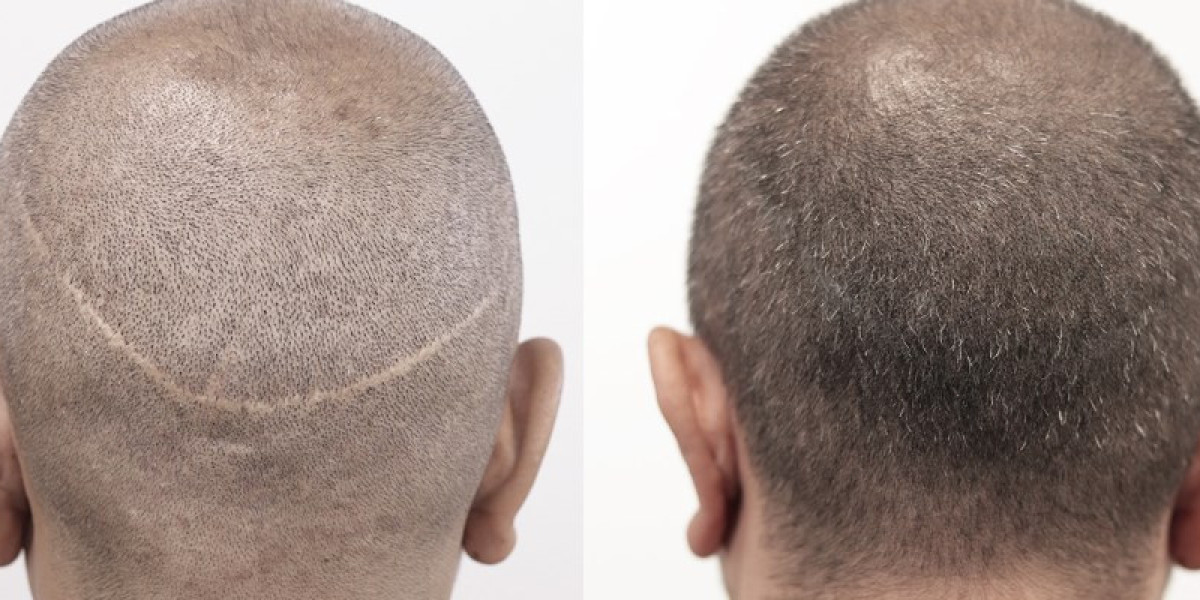 Hair Transplant Cost in Dubai and Best Age for Treatment
