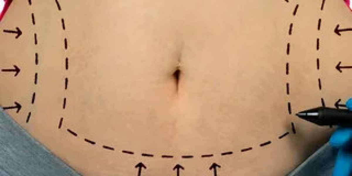 Preparing for Your First Fat Transfer Session: A Step-by-Step Checklist
