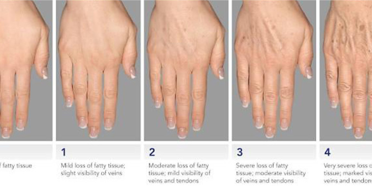 Managing Post-Treatment Swelling: Expert Advice for Best Results