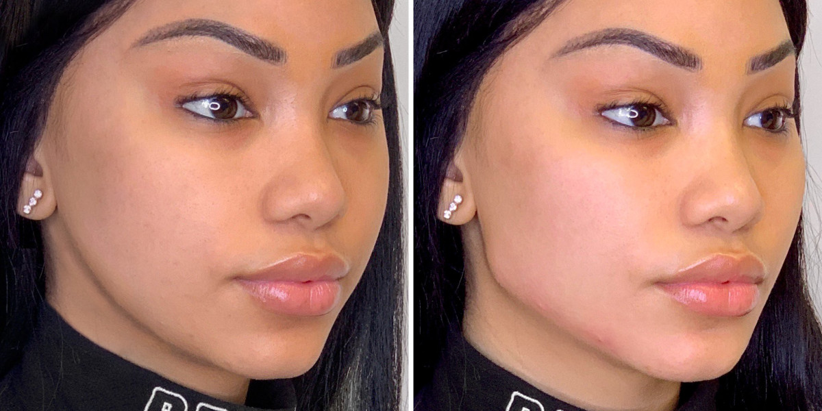 Brow Lift Surgery in Dubai and Skin Tightening Effects
