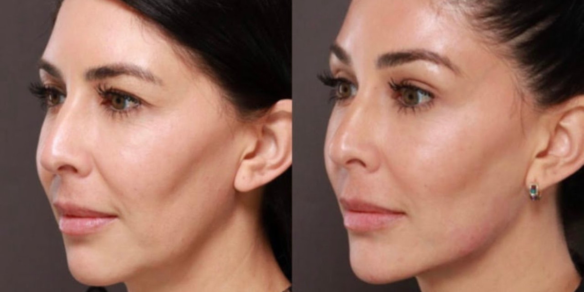 Cost of Jawline Contouring in Riyadh: A Patient’s Budgeting Guide