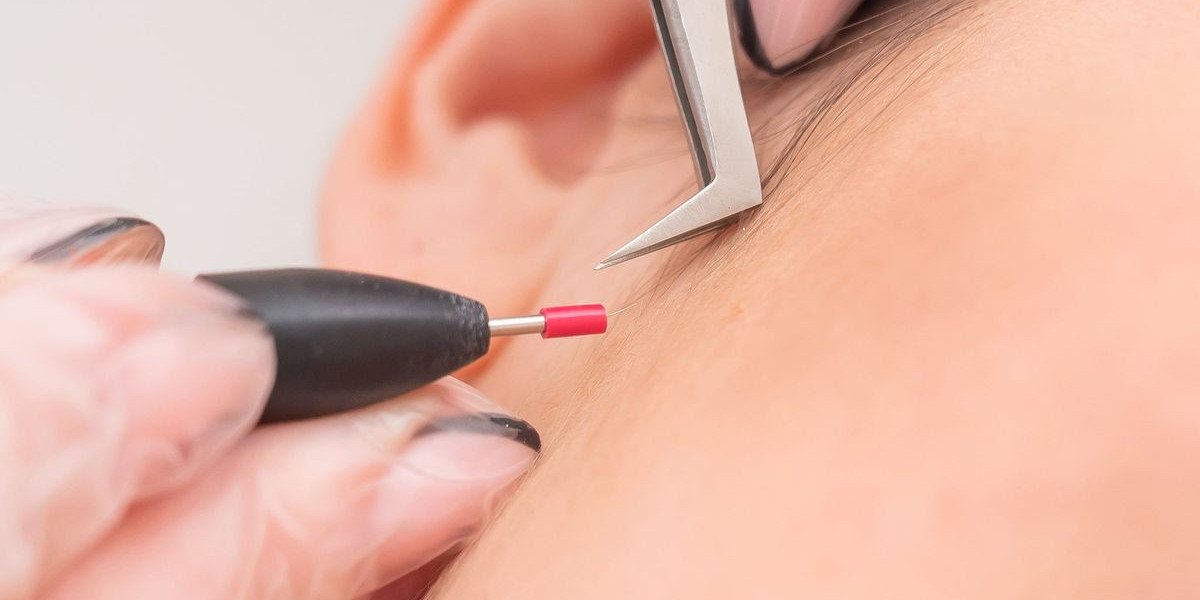 Electrolysis hair removal vs. Laser: Which Is Right for You?