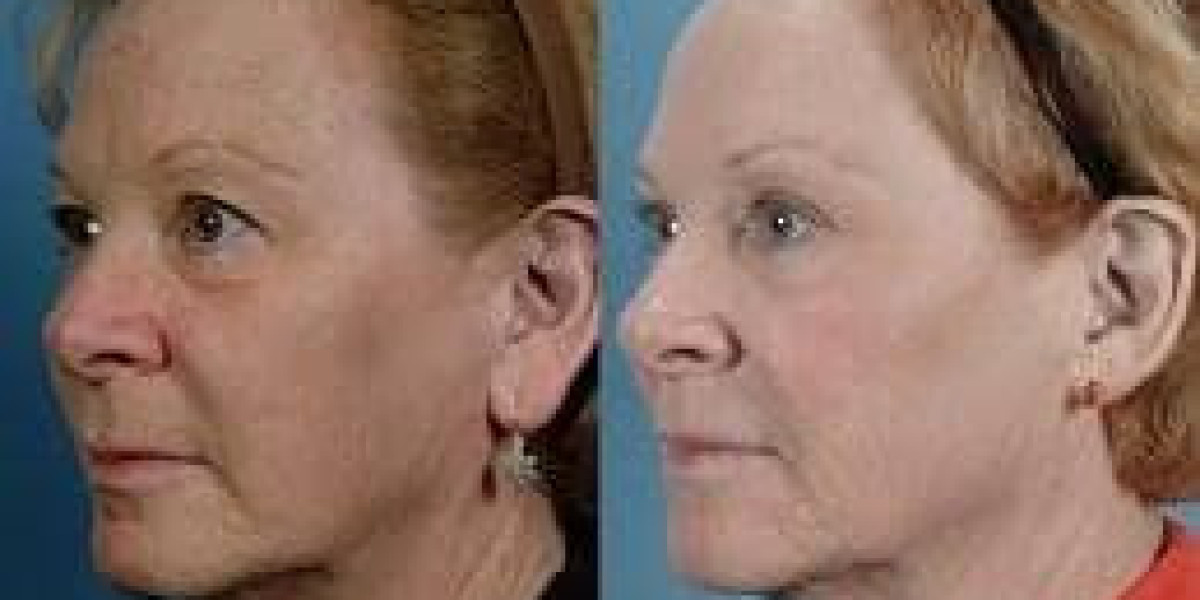 Earlobe Surgery in Dubai Cost and Value Guide