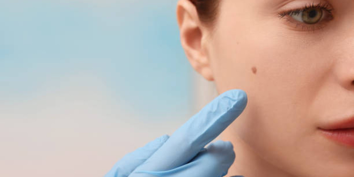 What Makes Mole Removal in Dubai Popular Today