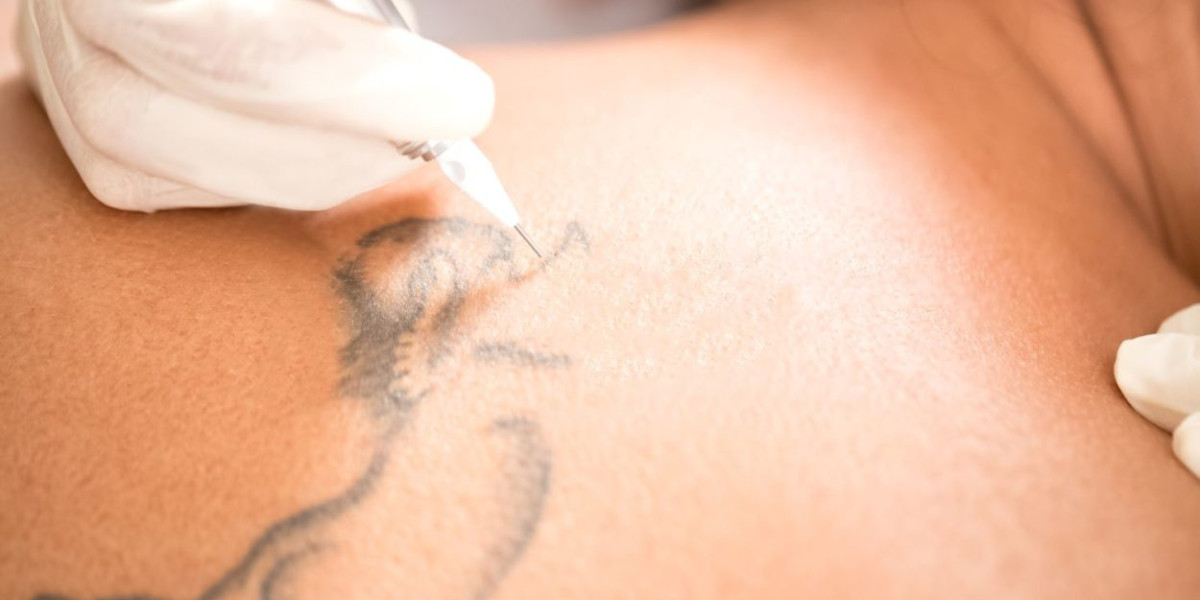 Tattoo Removal for Skin Sensitivity Issues