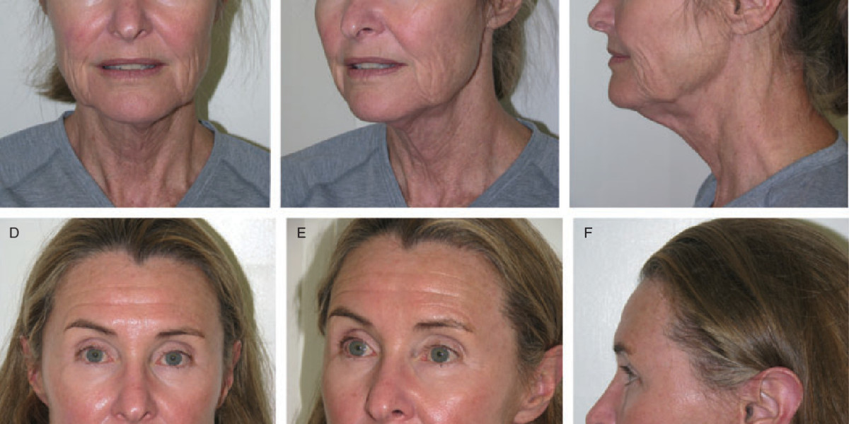 Natural-Looking Rejuvenation: The Vector Facelift Trend in Riyadh