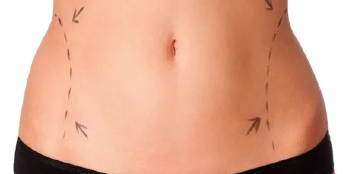 Transformative High Definition Liposculpture in Dubai