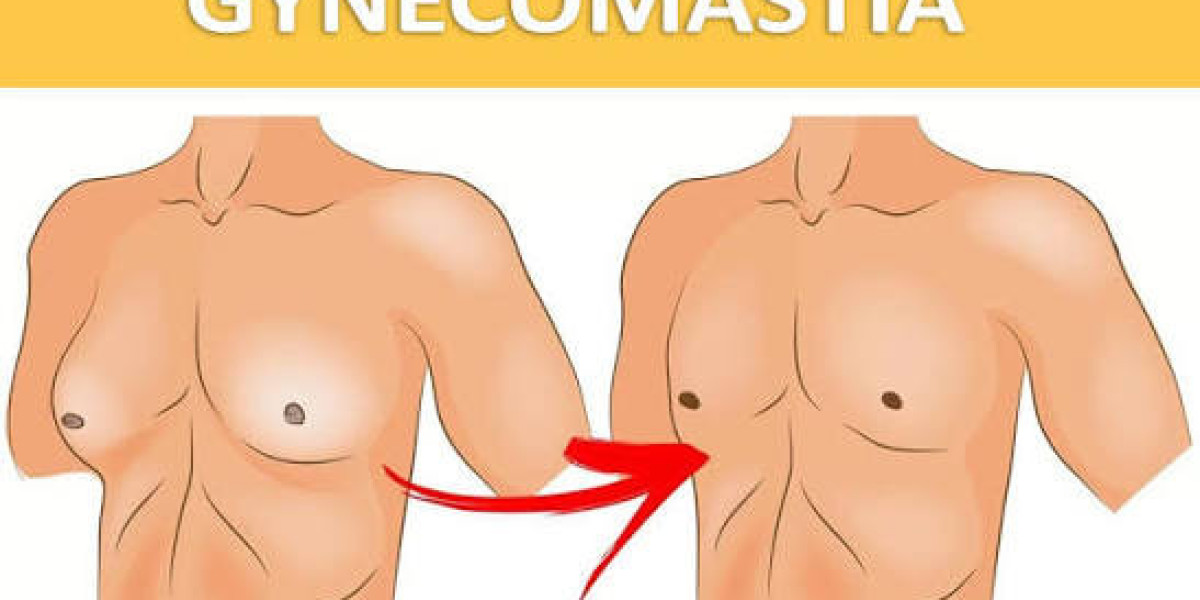 A Guide to Understanding Gynecomastia Treatment Options