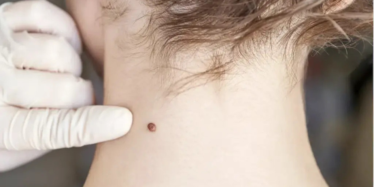 Mole Removal and Skin Healing Science in Dubai?