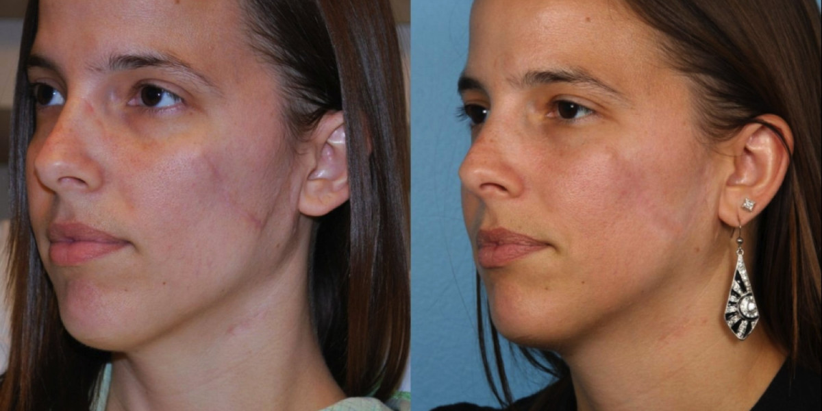 Scar Removal in Dubai: Non Surgical Methods Focus