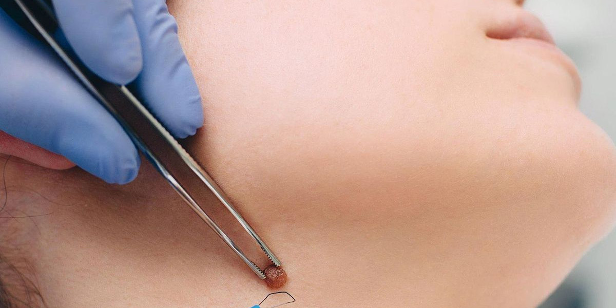 Advanced Mole Removal in Dubai: Your Guide to Safety
