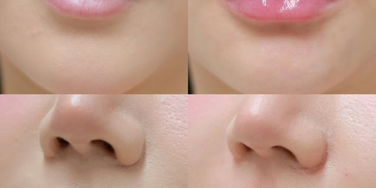 Lip Reduction Surgery in Dubai for Natural, Defined Lips