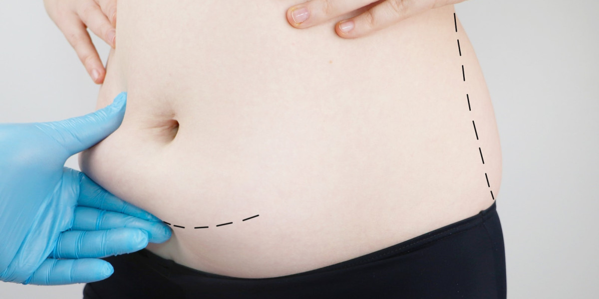 Mini Abdominoplasty in Dubai vs Full Tummy Tuck