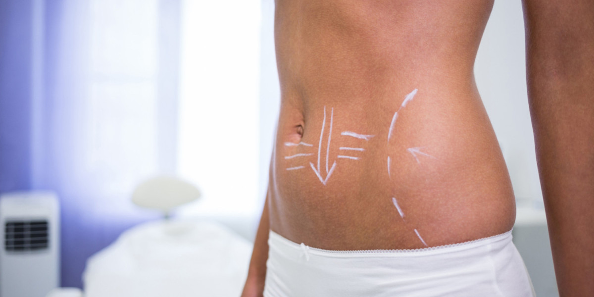 Fat Transfer Surgery Helps Achieve Balanced Curves with Natural Fullness