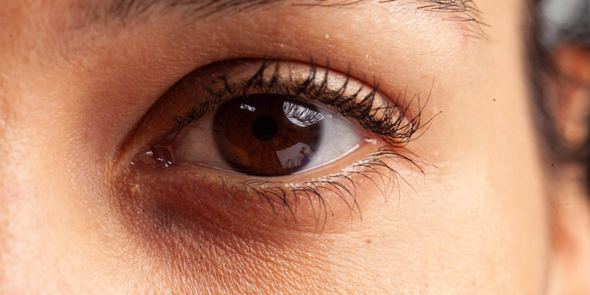 How Dark Circles Treatment Is Evaluated